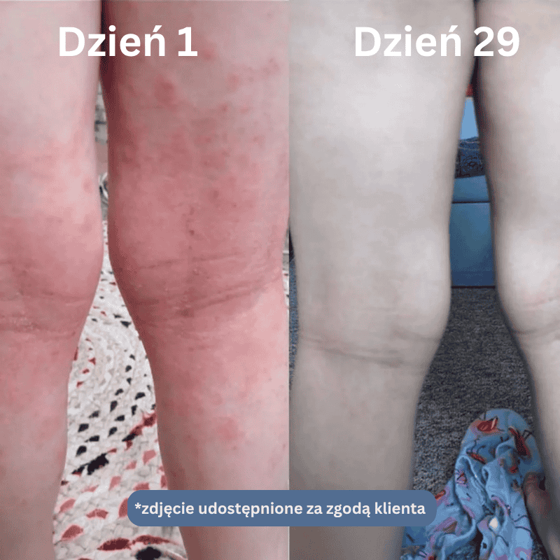 Nopsori- Natychmiastowe ukojenie dla skóry z łuszczycą i egzemą