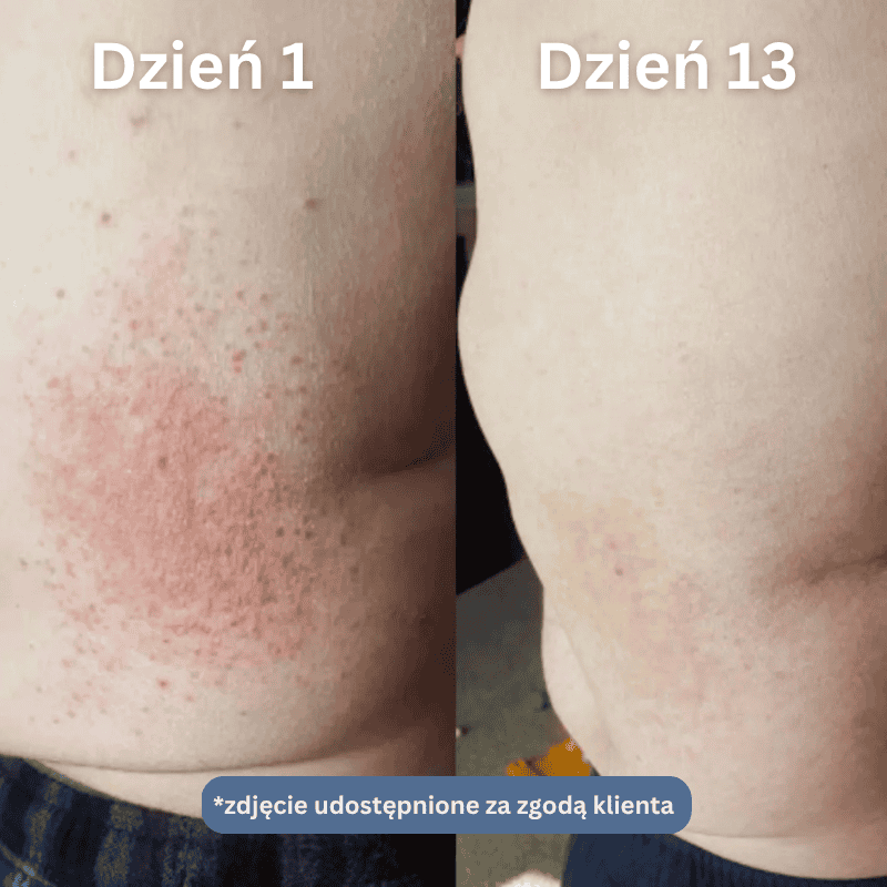Nopsori- Natychmiastowe ukojenie dla skóry z łuszczycą i egzemą